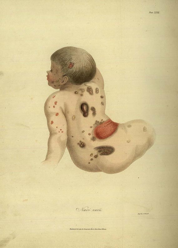 Thomas Bateman - Delineations of cutaneous diseases. 1840